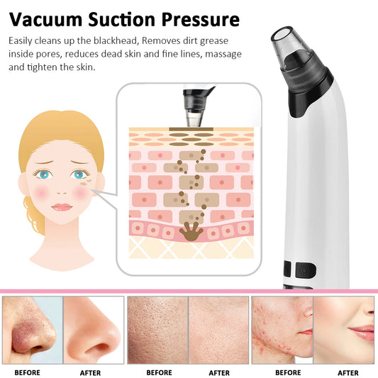 Beauty Electric Blackhead Remover – Vacuum Suction Facial Cleaner for Clear, Smooth Skin